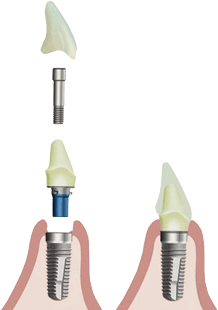 Bespiel für Implantate